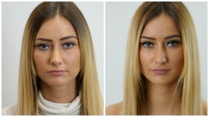 Lip Masterclass Dr Olha Before and After Lip Filler