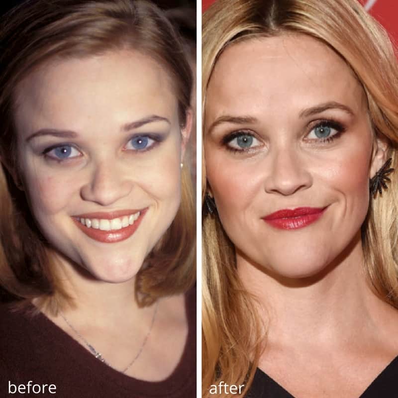 Chin Implants Before And After Celebrities
